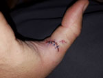 Matthew Randall's thumb all stitched up after a musky bit. Matthew Randall's stitched-up thumb after a musky bite